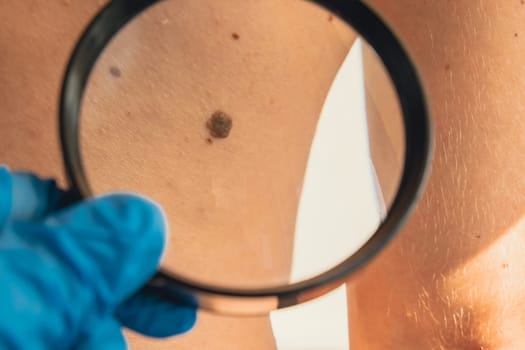 Mole dermoscopy, preventive of melanoma. Dermatologist examining patient's birthmark with magnifying glass in clinic. Checking benign moles. Skin abnormalities care concept.