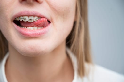 Close-up of a young woman's smile with metal braces on her teeth. Correction of bite.