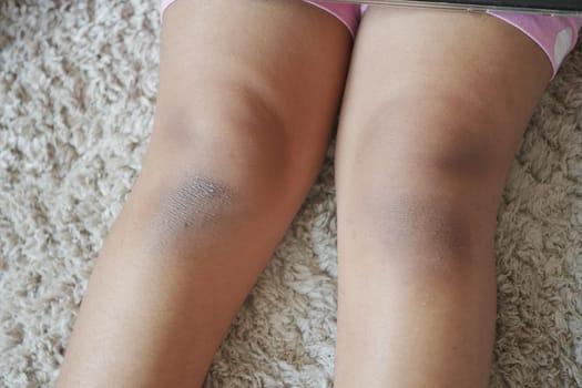 stain bruise wound on child knee