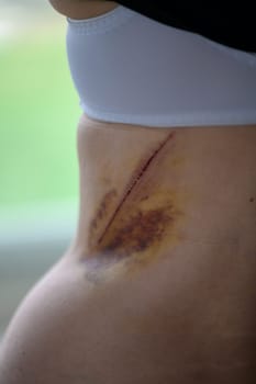 Close-up of a bruise on the wounded skin of a woman's back.