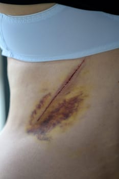 Close-up of a bruise on the wounded skin of a woman's back. 1