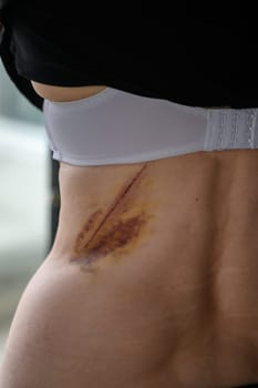 Close-up of a hematoma on a woman's back.