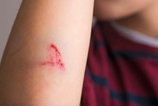 Close-up of a scratch on child's skin. Healthcare, injury concept. Closeup, macro shot, medical, health design for educational material.