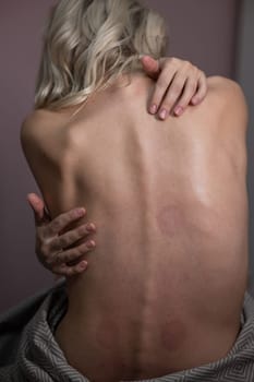 Caucasian woman after back massage with vacuum cups. Vertical photo