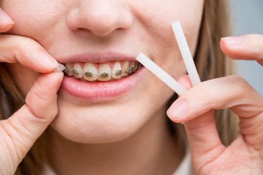 Close-up portrait of a woman with braces using special orthodontic wax