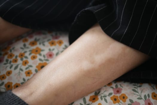 feet with vitiligo skin condition
