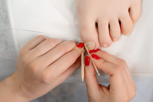 Podologist installs a titanium thread on the big toe for correction of ingrown toenail. Professional pedicure concept.