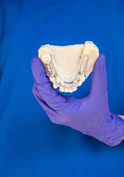 Dentist Holding Metal Frame Lower Partial Denture with Die Stone, Plaster Cast Molds Of Lower Jaws, Cobalt Chrome Dental Plate, 3D Printed Bridge. Vertical Plane. High quality photo