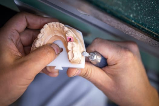 Dental technician's hands make new prosthetics in the lab.