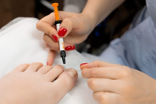 Podologist sets titanium toenail braces for woman.