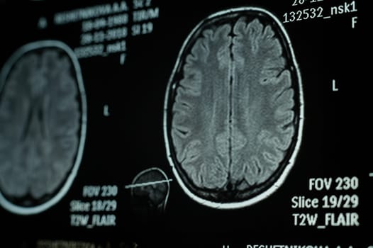 Close-up of magnetic resonance imaging of the human brain.