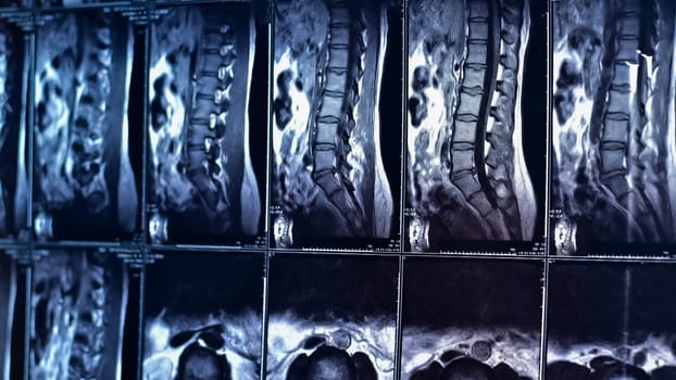 Magnetic resonance imaging of the lumbar spine