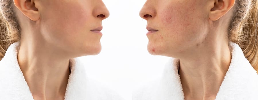 Before and After Skin Acne Treatment. Face of Woman in her 30s with Acne Problem, Couperosis, Scarring, Blackheads. Adult Skin Problem. Cosmetics and Healthcare, Beauty Concept. Rosacea. Horizontal.