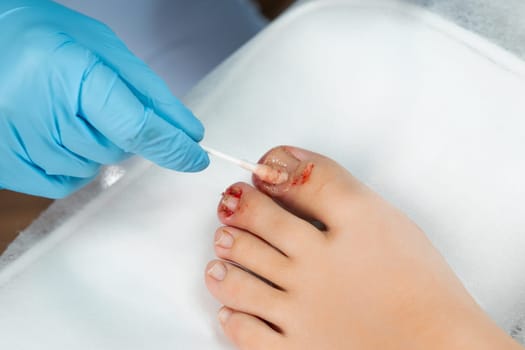 Close up podologist treats the nail with an antifungal agent.