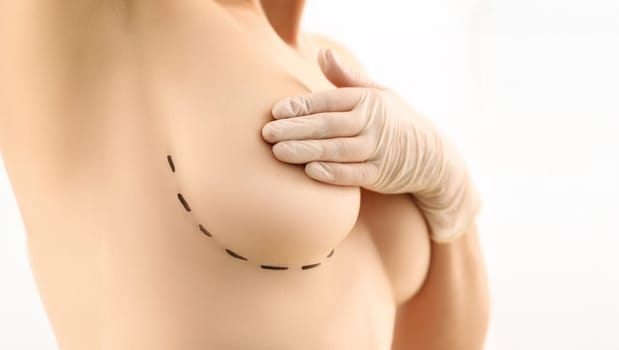 Woman Breasts Plastic Surgery Marker Line Mark. Topless Female with Lines on Skin for Operation on White Background. Lines on Girl Body for Medical Bust Improvement Procedure Partial View Shot