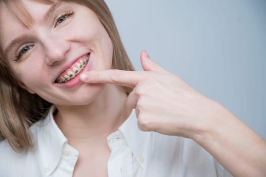 A beautiful red-haired girl smiles and points to the braces. Young woman corrects bite with orthodontic appliance.