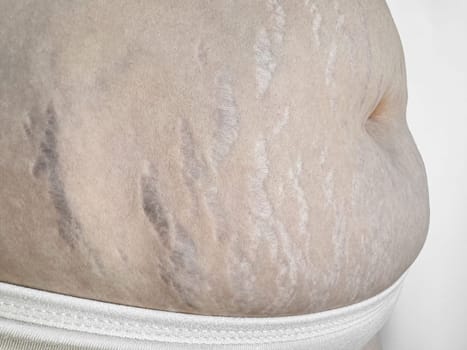 Close up of stretch marks on womans skin, highlighting natural beauty and the concept postpartum changes. High quality photo