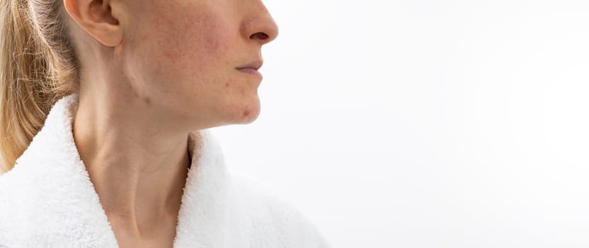 Design Cropped Face of Woman in her 30s with Acne Problem, Couperosis, Scarring, Blackheads. Horizontal Plane. Copy Space. Adult Skin Problem. Cosmetics and Healthcare, Beauty Concept. Rosacea