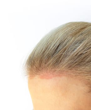 Closeup Cropped Caucasian Female Face with Sunburn Skin On Scalp, Forehead Under Hair, White Background. White Woman Suffers From Face Sun Burn. UV Danger. Copy Space.