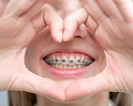 Caucasian woman in braces holding fingers in the shape of a heart