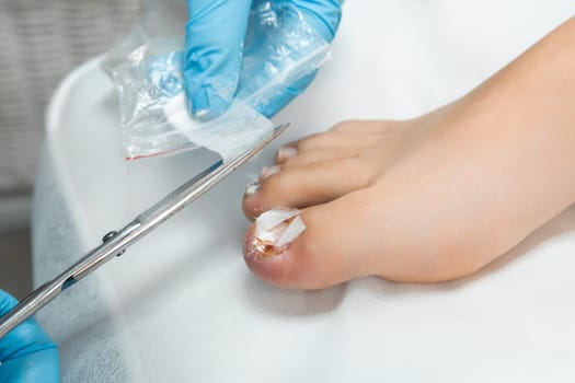 Close up podiatrist applies a bandage after an ingrown toenail removal procedure.