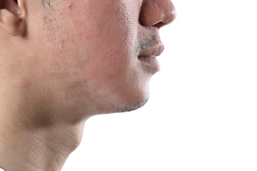 Man undergoing CO2 laser resurfacing for facial rejuvenation isolate on white background.