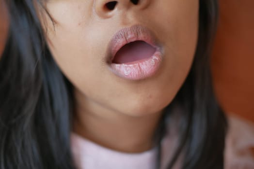 close up of dry lip of a child ,