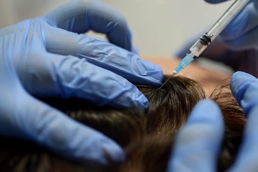 Hair regeneration, Plasma injection into the hair on a woman 's head .a cosmetologist makes plasma injections into the scalp.