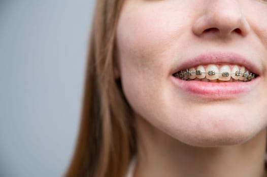 Unrecognizable red-haired girl with braces smiles. Young woman corrects bite with orthodontic appliance