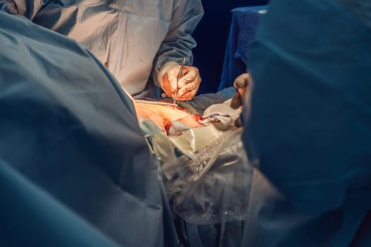 Shot In Operating Room of Two Surgeons During the Surgery Procedure Bending Over Patient with Instruments. Professional Doctors in Modern Hospital