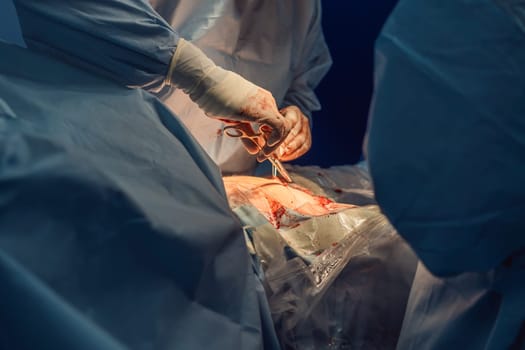 Shot In Operating Room of Two Surgeons During the Surgery Procedure Bending Over Patient with Instruments. Professional Doctors in Modern Hospital