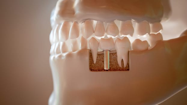 This 3D rendering illustrates a dental implant procedure, showing the implant anchored in the jawbone and supporting a crown.