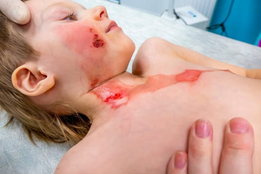 medical procedure dressing a boy with a first-degree burn from boiling water on his face, neck and chest