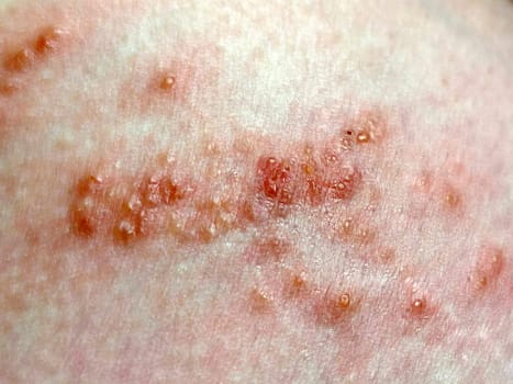 viral hepatitis, red blisters and rashes on the skin close-up.