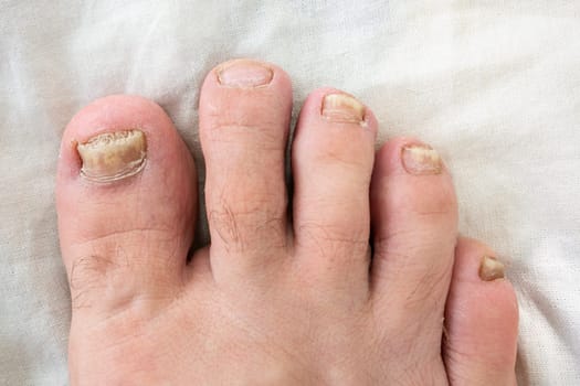 Part of a man's foot with nails affected by fungus, top view.