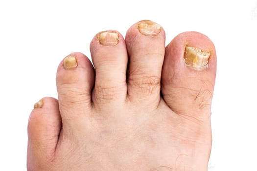 Male foot with nails damaged by fungus on a white isolated background, top view.