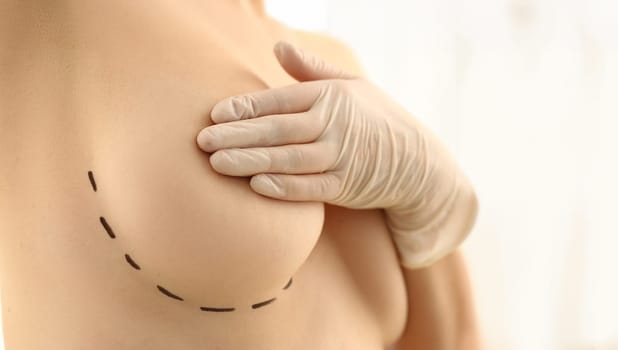 Close-up of woman close nipple with hand, linear marking on boob, cosmetic surgery operation. Patient prepare for beauty procedure. Plastic surgery concept