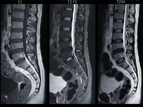 MRI L-S spine or lumbar spine Sagittall T1W ,T2 FS and T2W view  for diagnosis spinal cord compression.