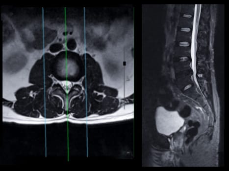 MRI L-S spine or lumbar spine Axial T2W view with sagittal plane for diagnosis spinal cord compression.