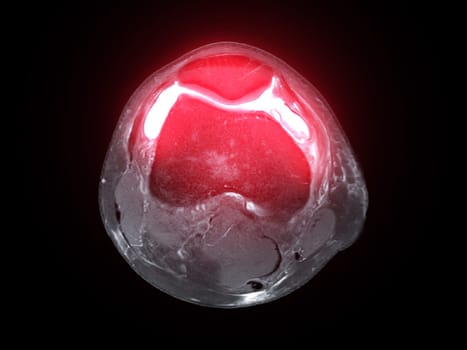 Magnetic resonance imaging or MRI of  knee joint Axial T2 FS view for detect tear or sprain of the anterior cruciate  ligament (ACL)