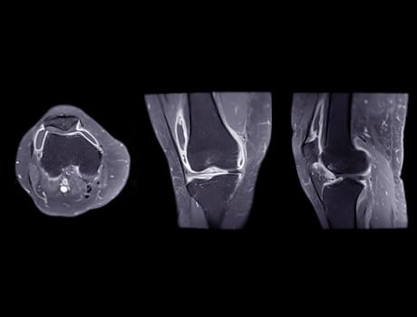 Magnetic resonance imaging or MRI of  knee joint Axial ,Coronal and sagittal T2 FS for detect tear or sprain of the anterior cruciate  ligament (ACL)