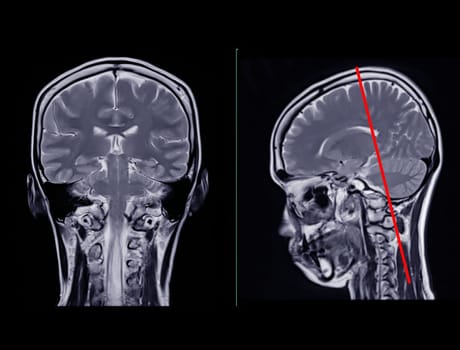 MRI  brain scan  Compare Coronal and sagittal plane for detect  Brain  diseases sush as stroke disease, Brain tumors and Infections.