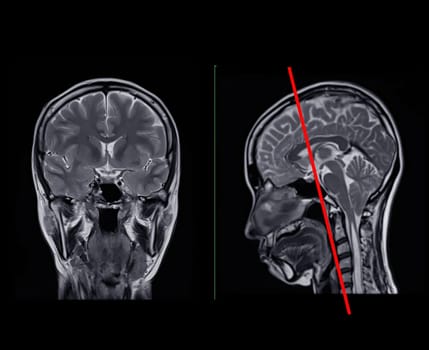 MRI  brain scan  Compare Coronal and sagittal plane for detect  Brain  diseases sush as stroke disease, Brain tumors and Infections.