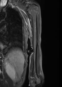MRI Left humerus bone for diagnosis bone tumor.