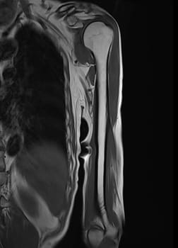 MRI Left humerus bone for diagnosis bone tumor.