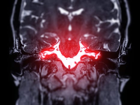 MRI Brain scan  with  the internal auditory canal (IAC) Coronal view. 