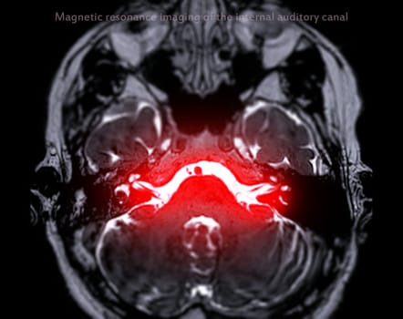 MRI Brain scan  with  the internal auditory canal (IAC) axial view. 