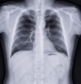 Chest x-ray image , Normal Chest.