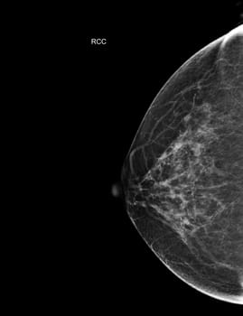  X-ray Digital Mammogram Right side  CC view . mammography or breast scan for Breast cancer  showing BI-RADS CATEGORY 2  Benign tumor.
