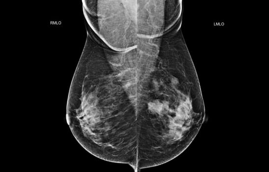 X-ray Digital Mammogram both side MLO view . mammography or breast scan for Breast cancer BI-RADS 5; Highly suggestive of malignancy .